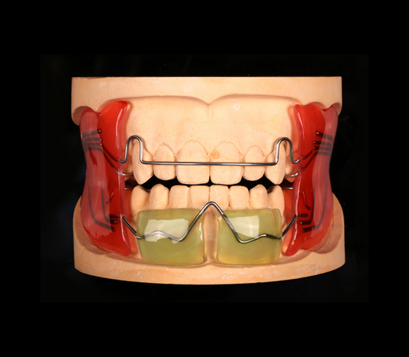 法兰克功能矫治器Ⅱ型